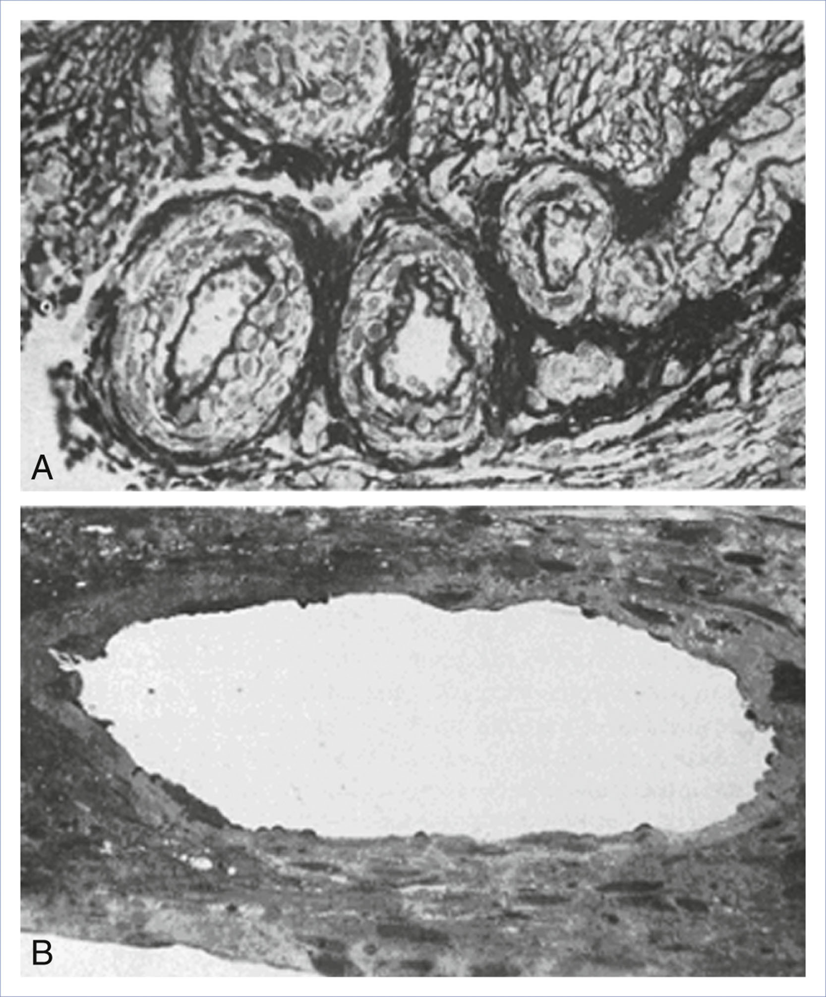 A histologic comparison of spiral arteries in nonpregnant and late pregnant uterus is shown in two labeled sections A and B.
