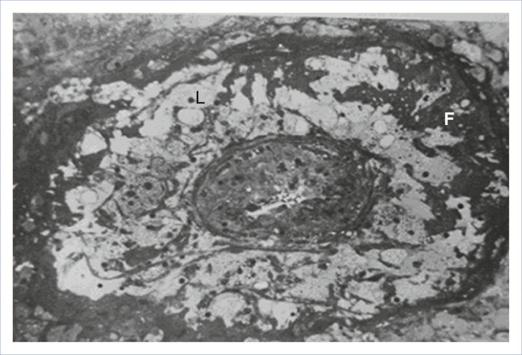An occluded decidual vessel contains lipid-laden cells labeled L and fibrin deposition labeled F.