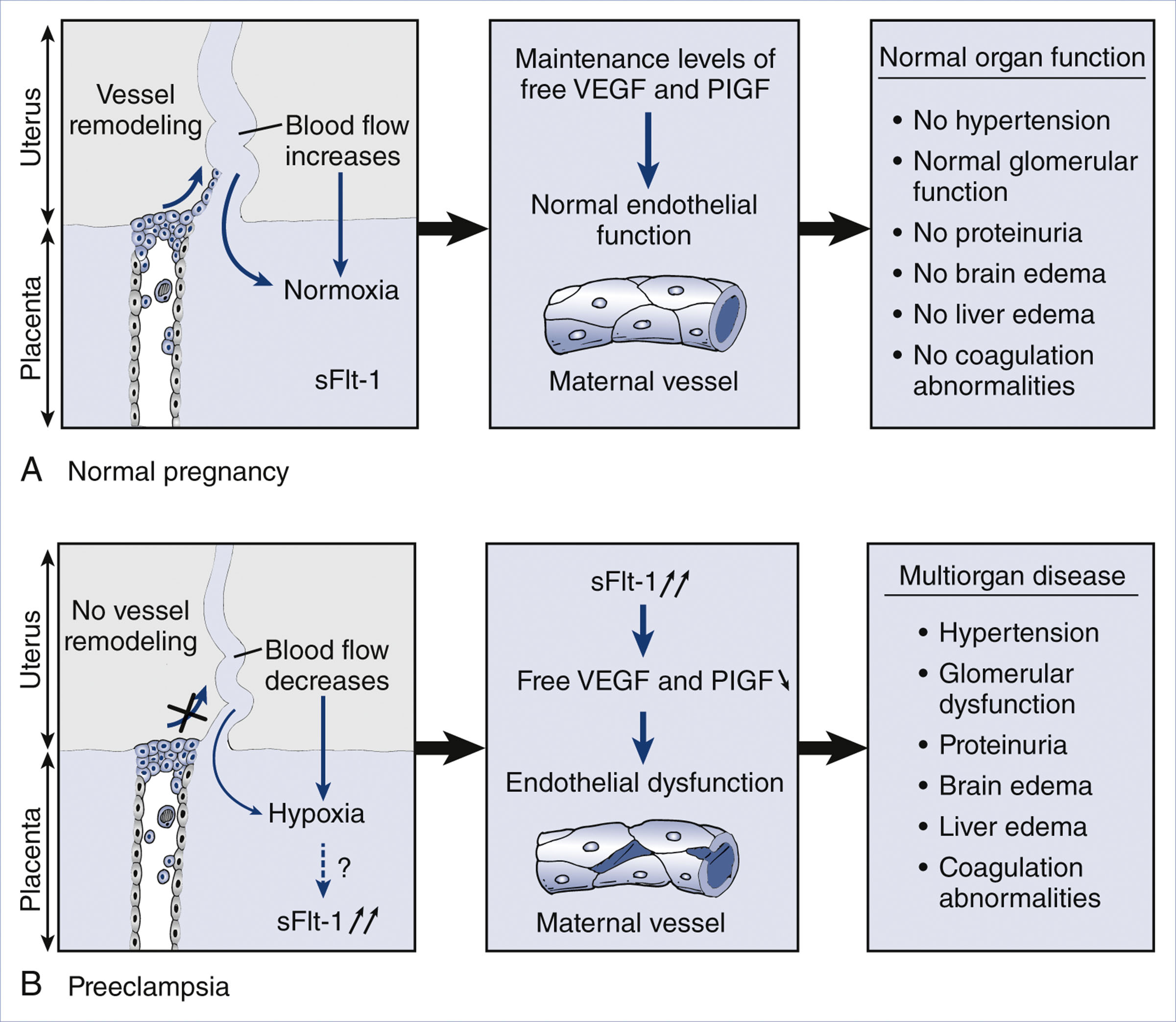 A comparative diagram illustrates normal pregnancy and preeclampsia through uteroplacental blood flow, endothelial function, and organ outcomes.
