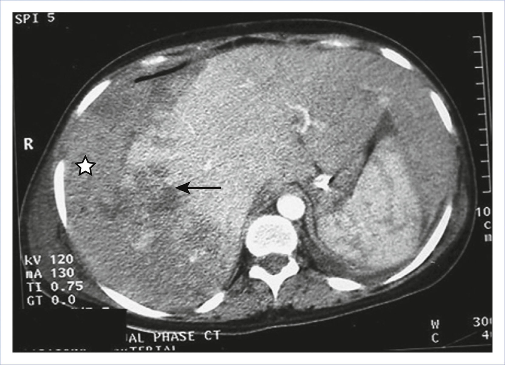 A contrast-enhanced computed tomography scan shows hepatic rupture and subcapsular hematoma in the right lobe of the liver.