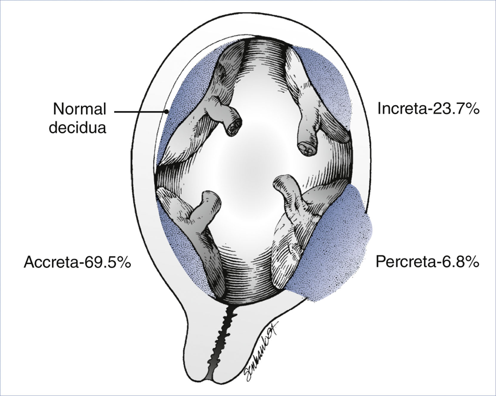 An anatomical diagram shows abnormal placental implantation types with labeled regions and corresponding percentages.