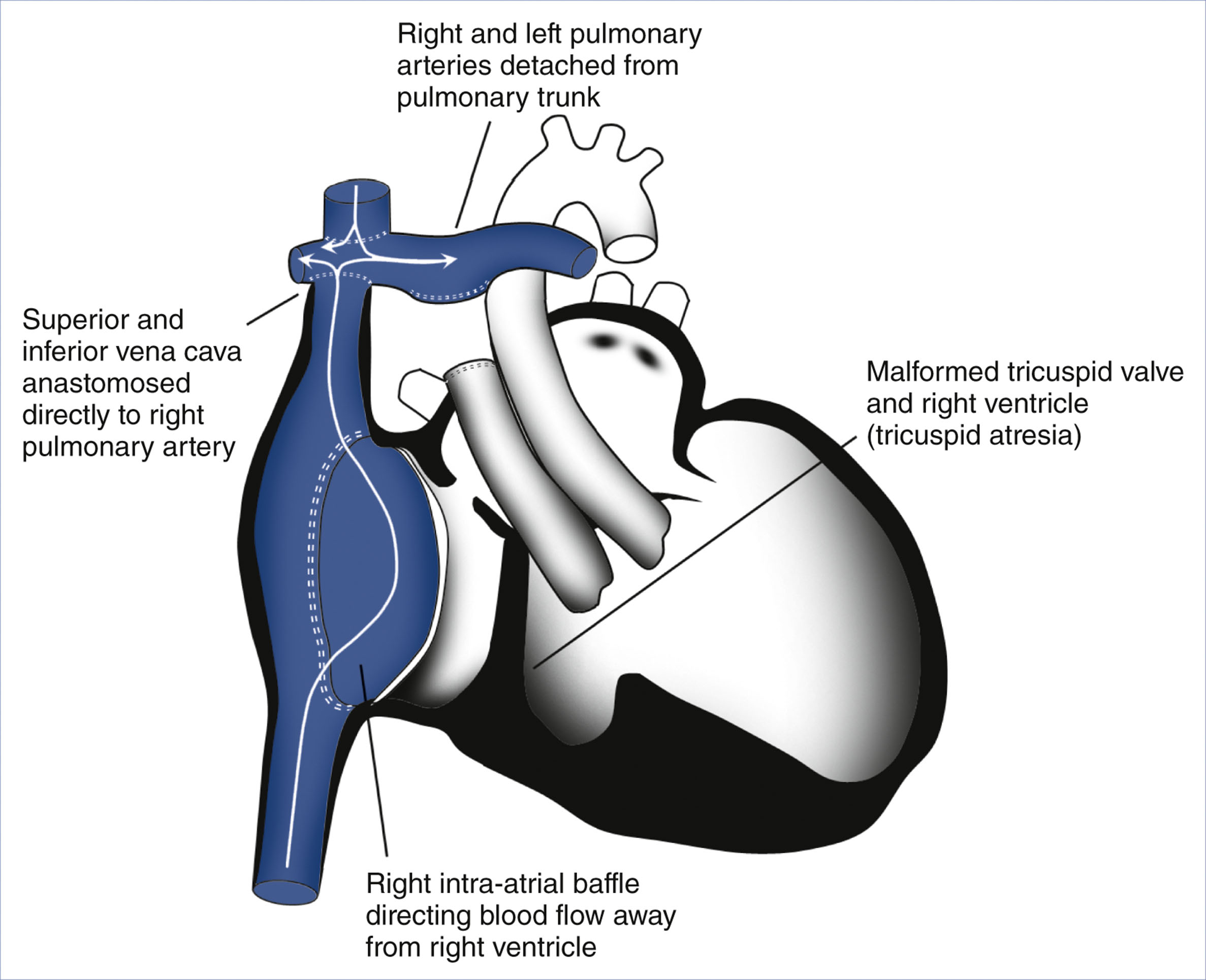 A schematic of Fontan repair shows rerouted venous blood flow bypassing the malformed right heart.
