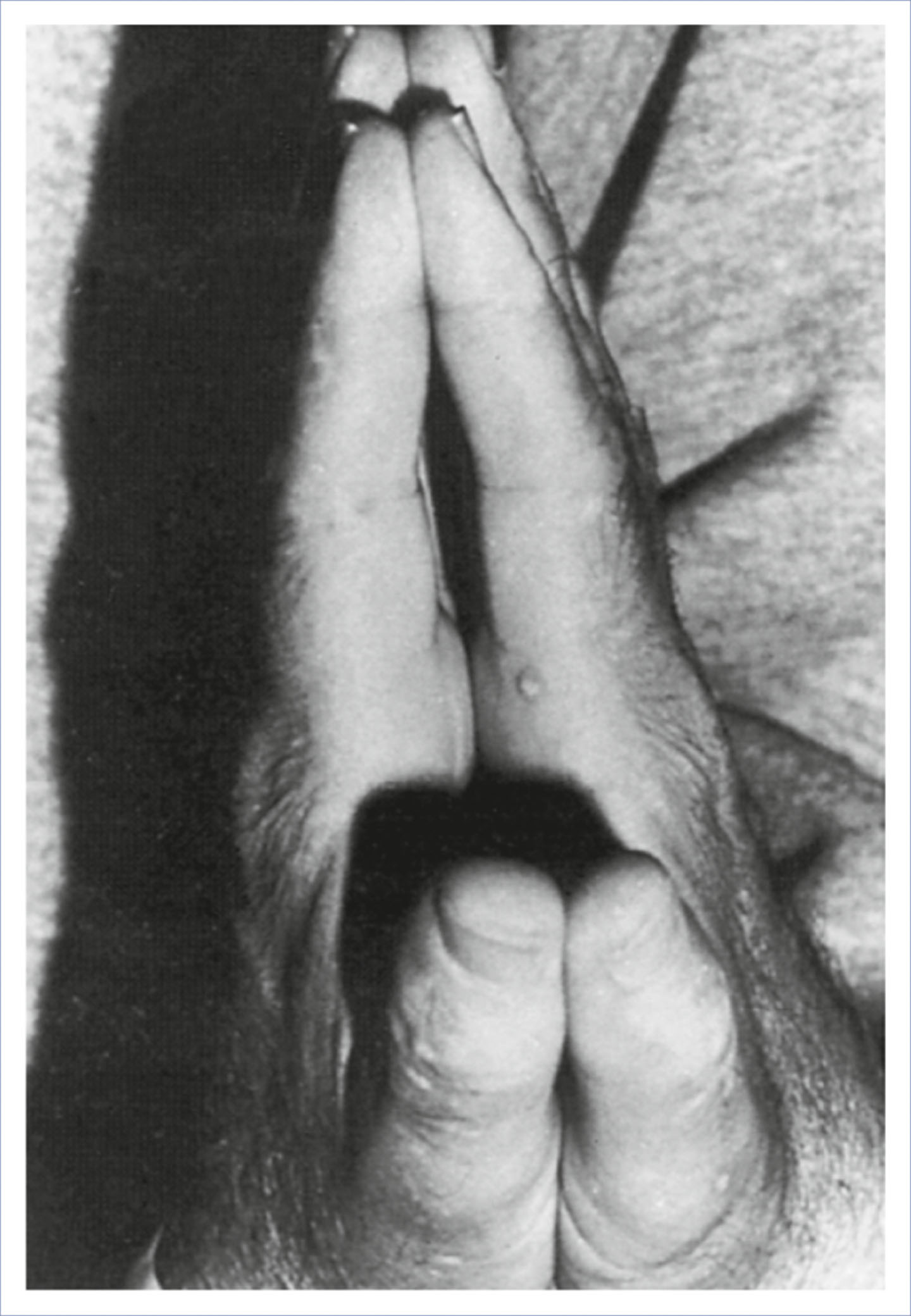 A photograph shows a pair of hands placed together with fingers unable to fully align at the joints.