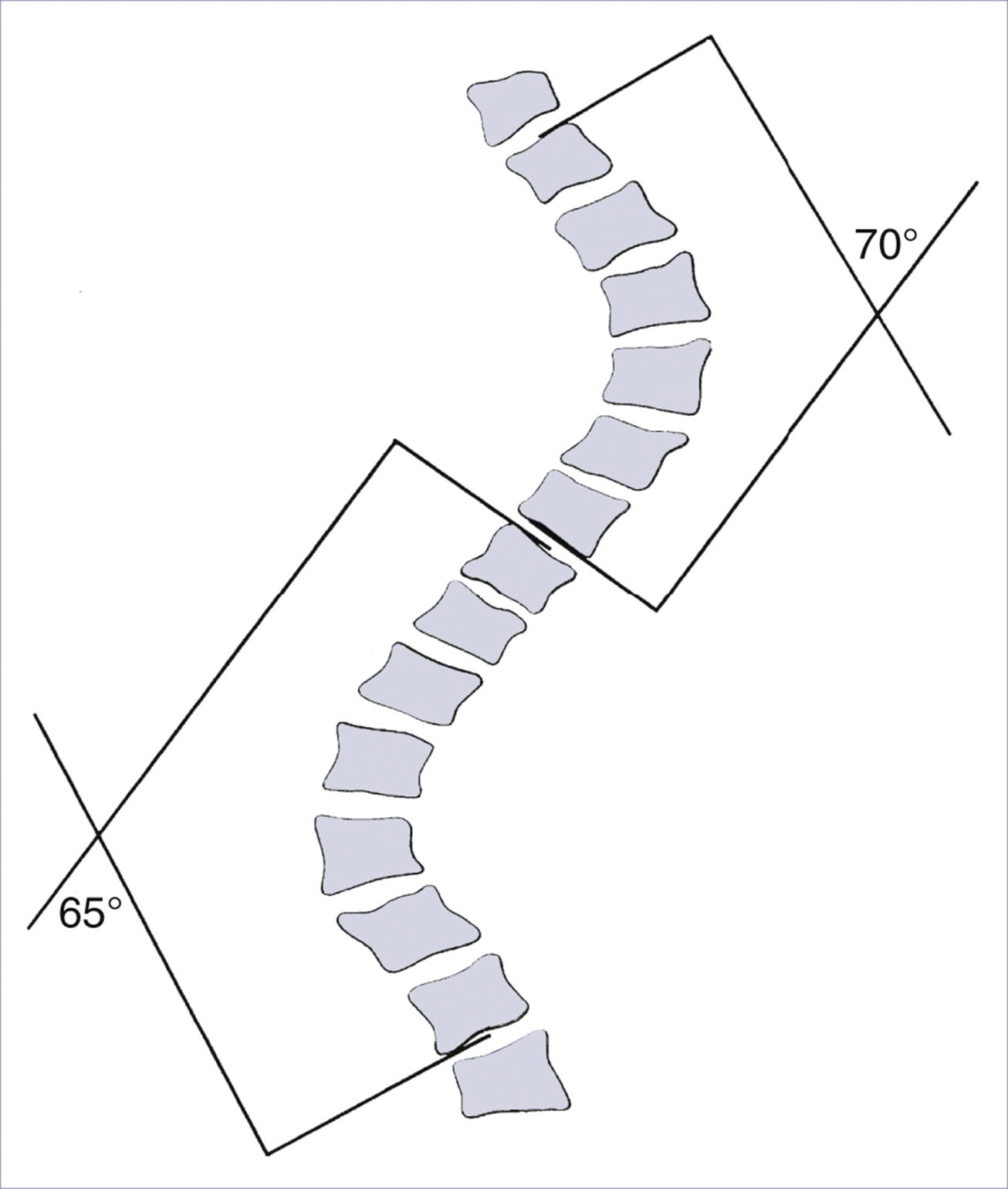 A schematic shows a curved spine with intersecting angle lines measuring sixty-five and seventy degrees.