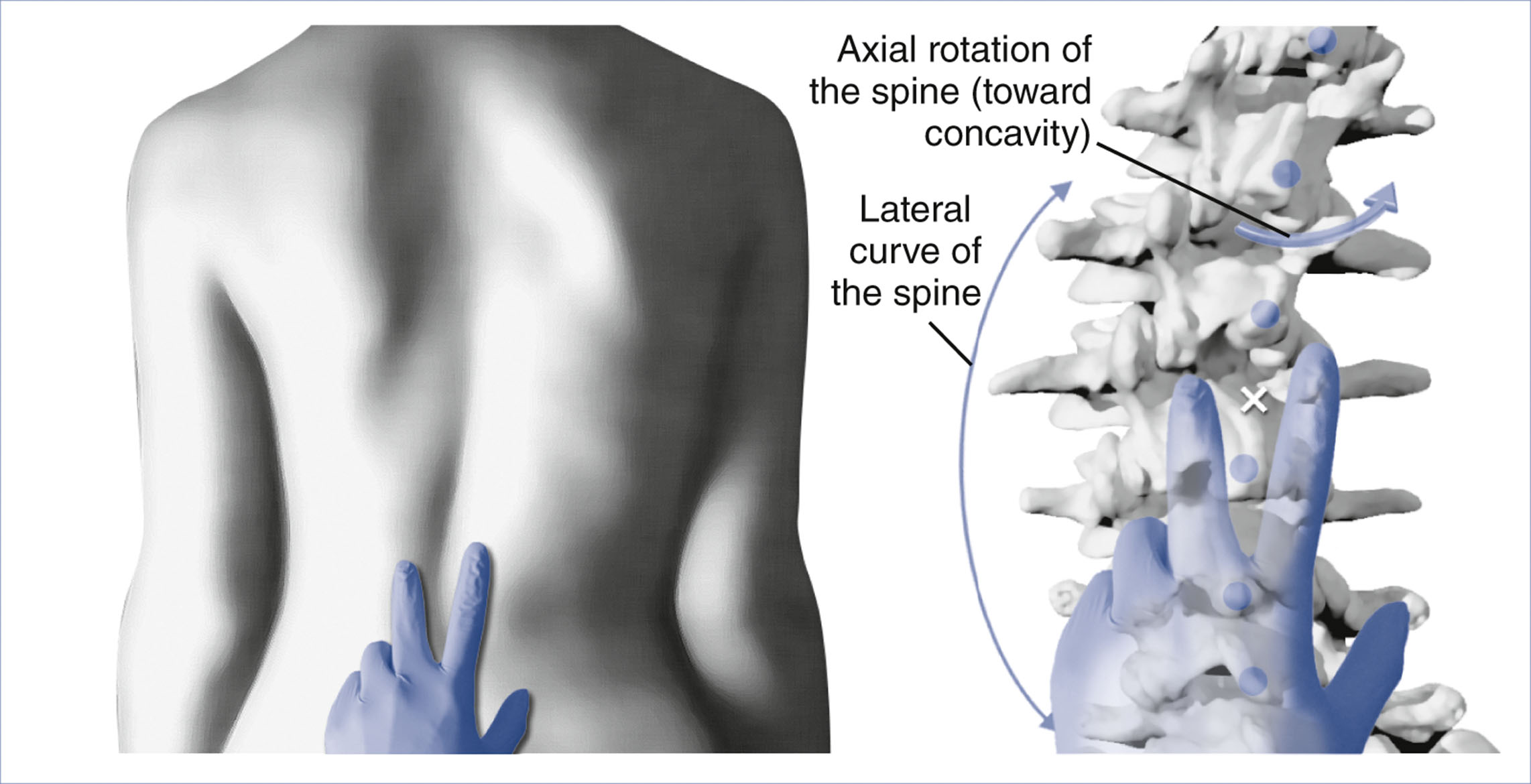 A schematic shows spinal rotation and lateral curvature in a patient with scoliosis, alongside a skeletal illustration that indicates vertebral shift.