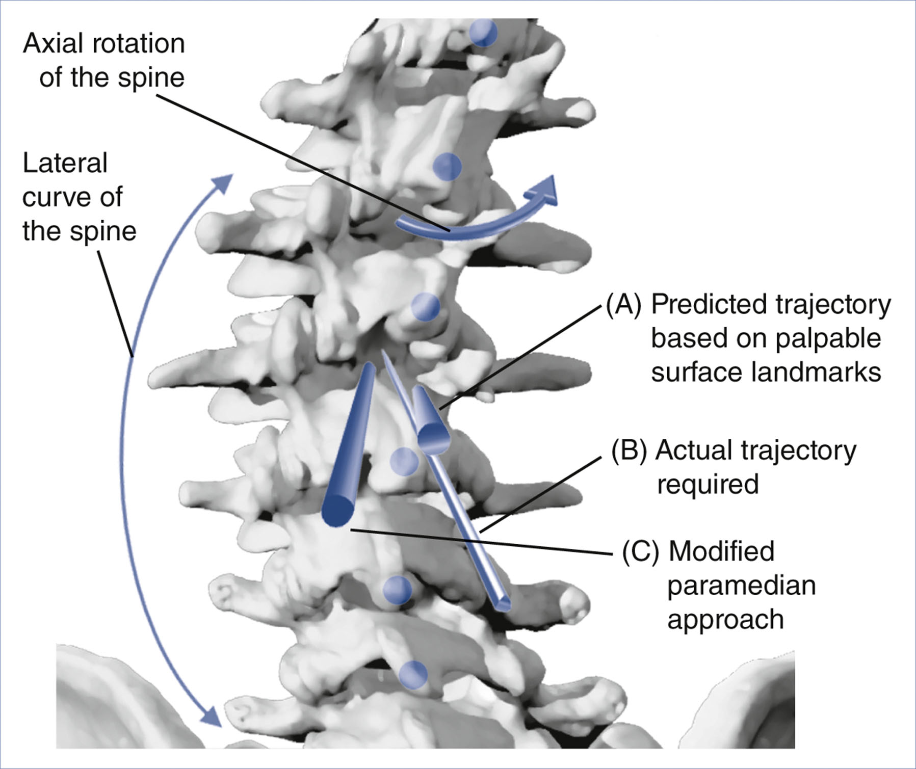 A schematic shows axial and lateral spinal curvature with three labeled needle trajectories for epidural access.