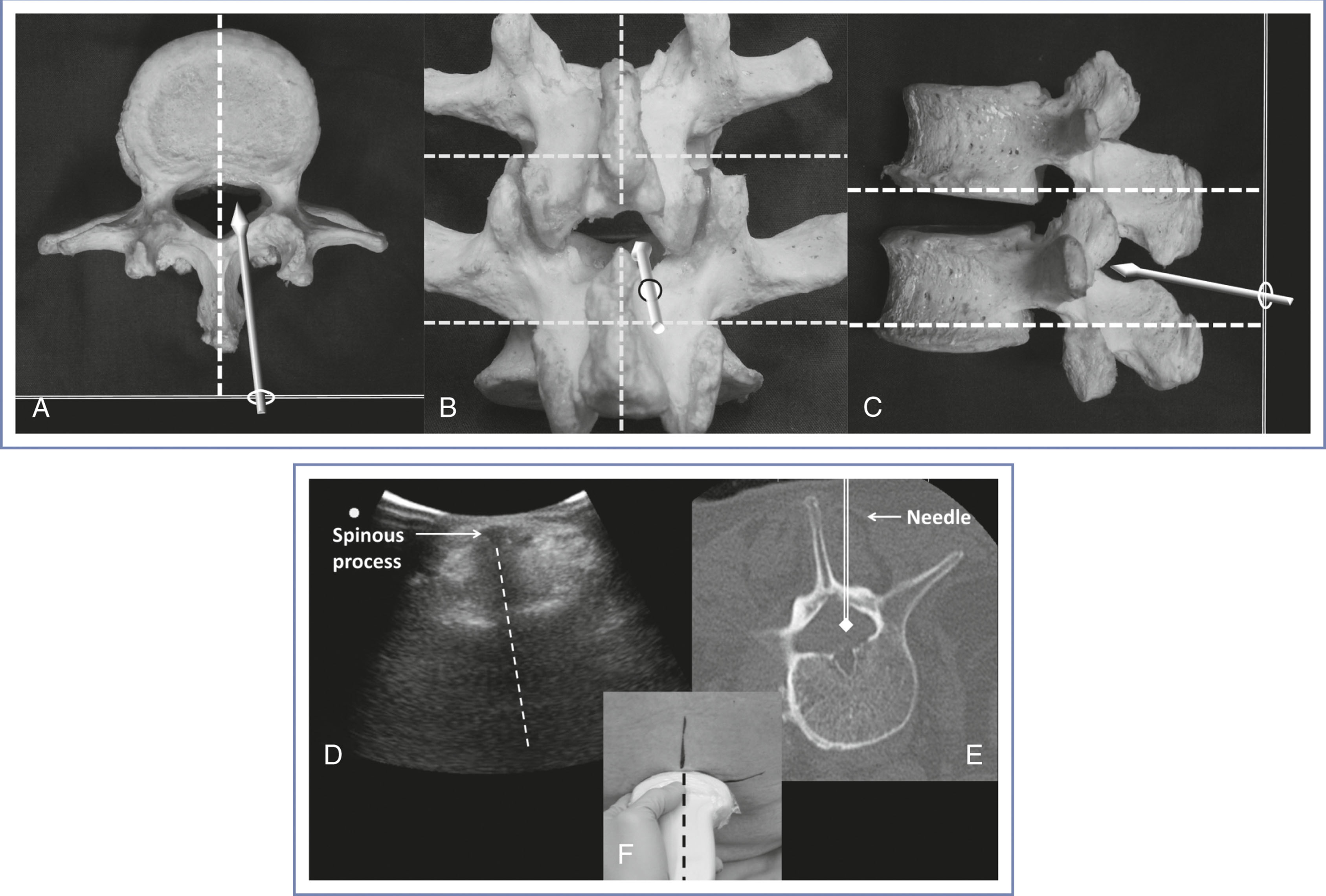 A schematic shows vertebral views and guided neuraxial needle insertion techniques across six panels.