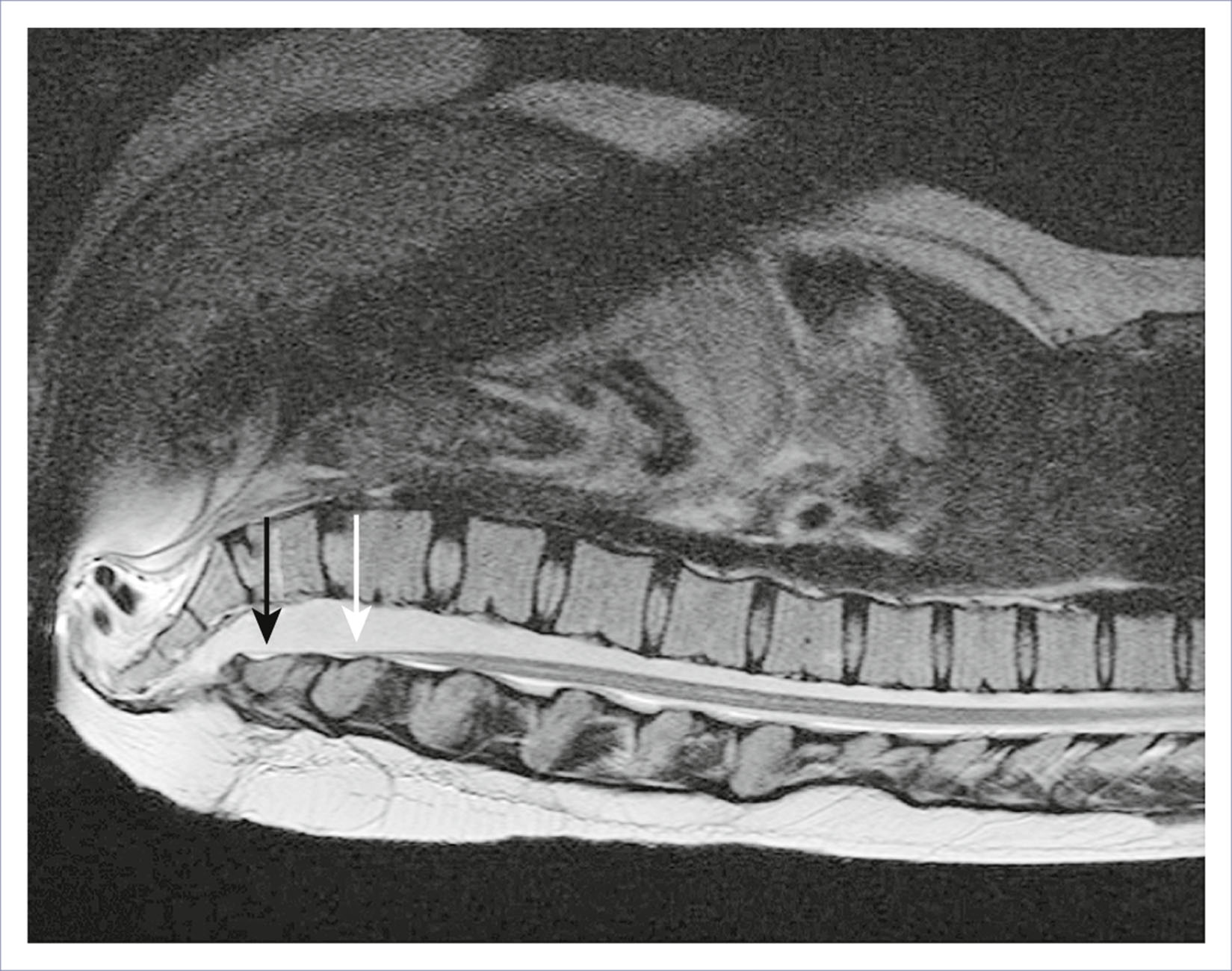 A magnetic resonance scan shows the spine in sagittal view with two arrows marking spinal structures.