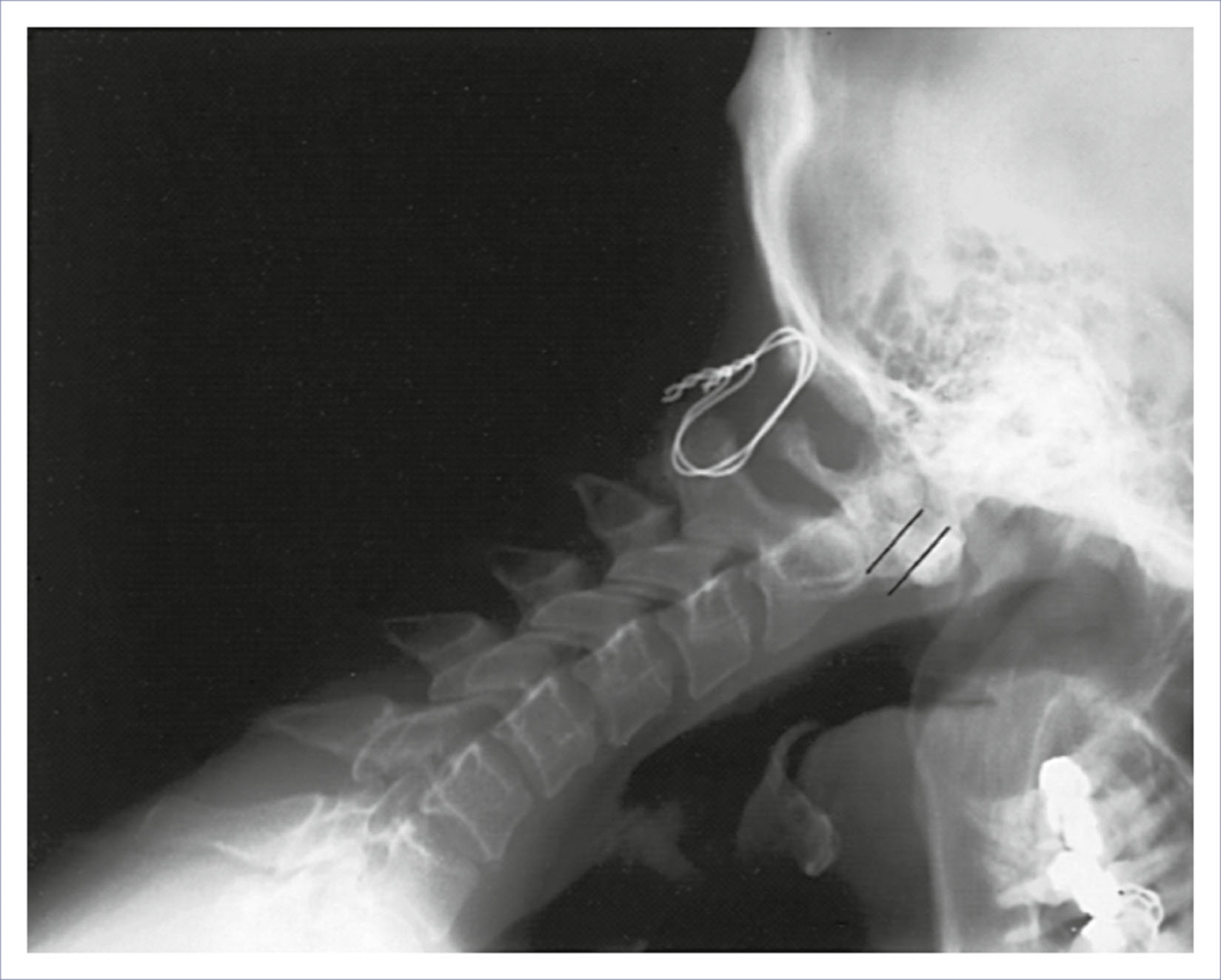 A lateral radiograph shows the cervical spine in flexion with a wire placed between the occiput and cervical vertebra.