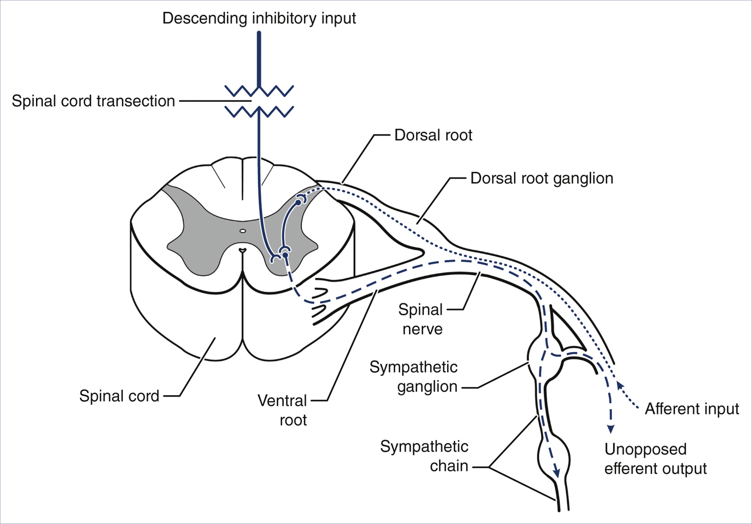 A diagram shows spinal cord transection disrupting descending inhibitory input and resulting in unopposed sympathetic output.