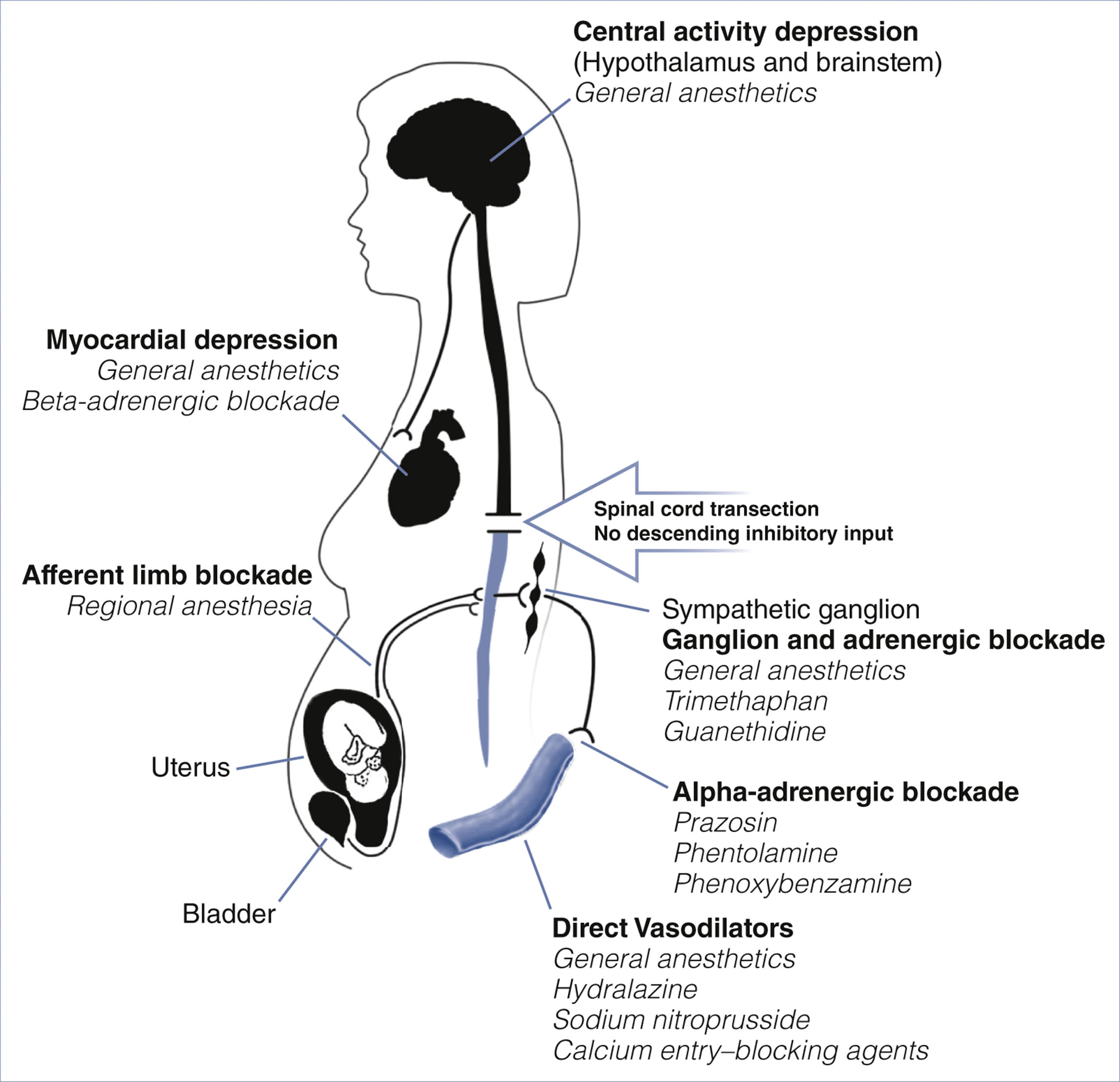 A diagram of a female body shows sites where various drugs act to control hypertension caused by autonomic hyperreflexia.
