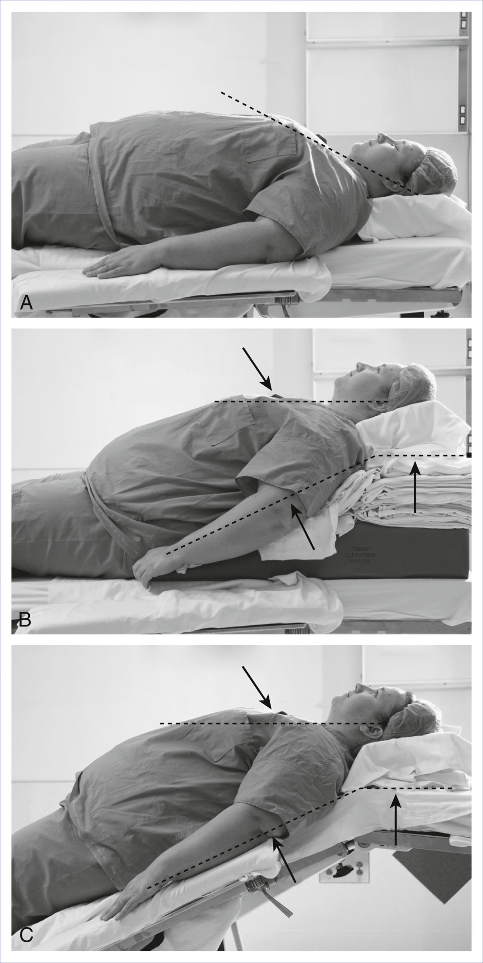 A three part photo series compares patient positioning methods to align the external auditory meatus and sternal notch for intubation.
